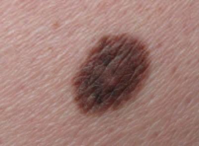 Compound Naevus linke Gesäßhälfte