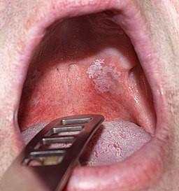 Leukoplakie