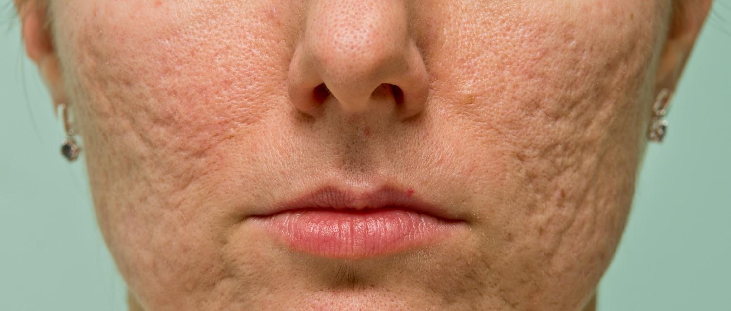 Hilft Bio-Öl bei Aknenarben?