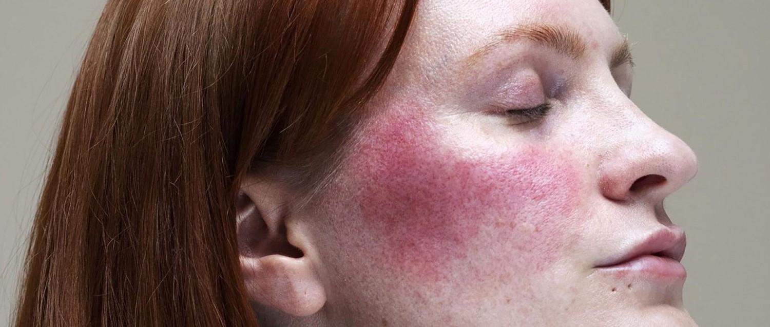 rosacea treatments