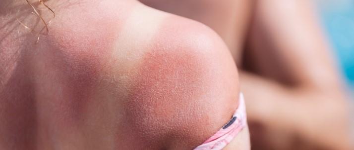 Sonnenbrand Blasen