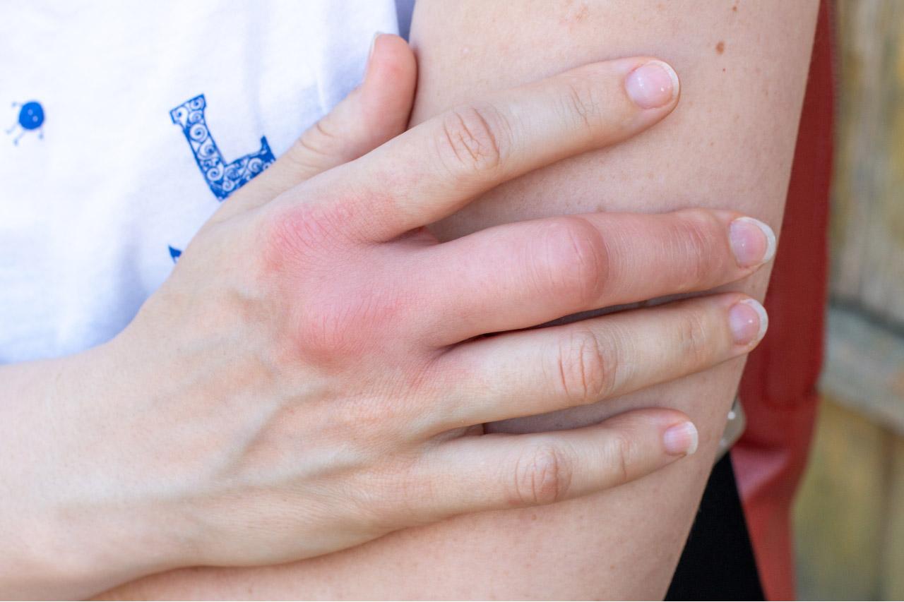 Foto eines Wespenstichs an einer Hand