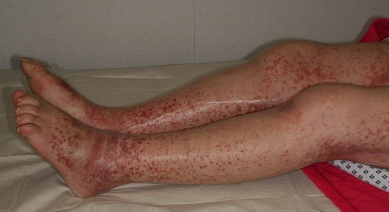 Purpura Henoch-Schönlein