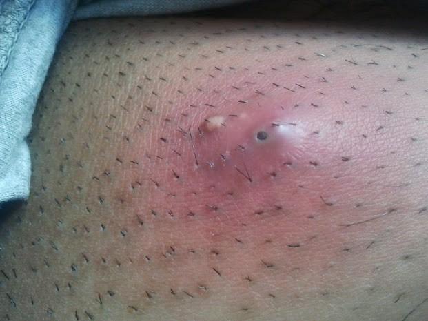 Fünf Tage alter Abszess