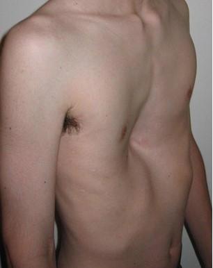 Pectus excavatum