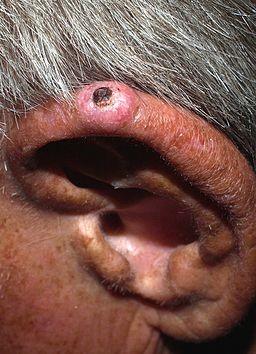 Chondrodermatitis nodularis