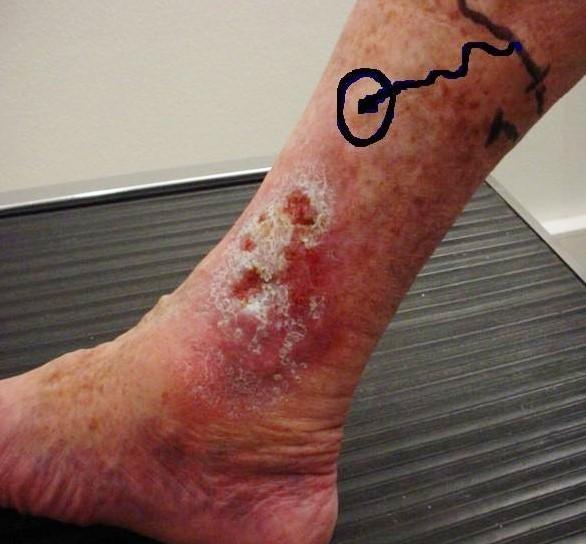 Venous leg ulcer