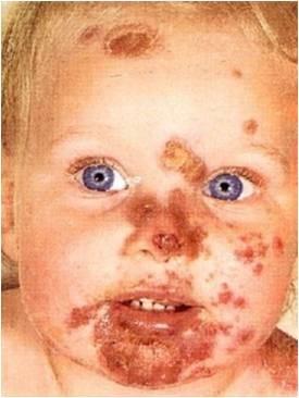 Impetigo im Gesicht