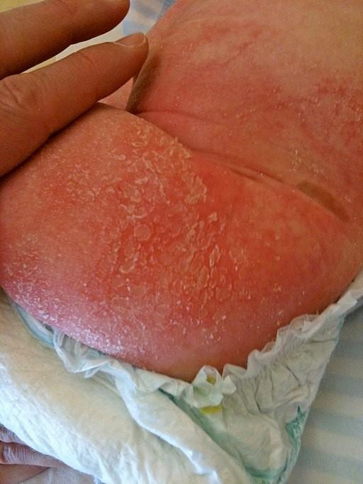 Atopic dermatitis child